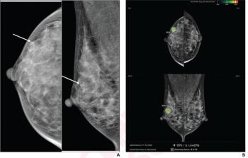 Mammography Study Assesses Ability of AI to Predict DCIS Recurrence After Breast Surgery