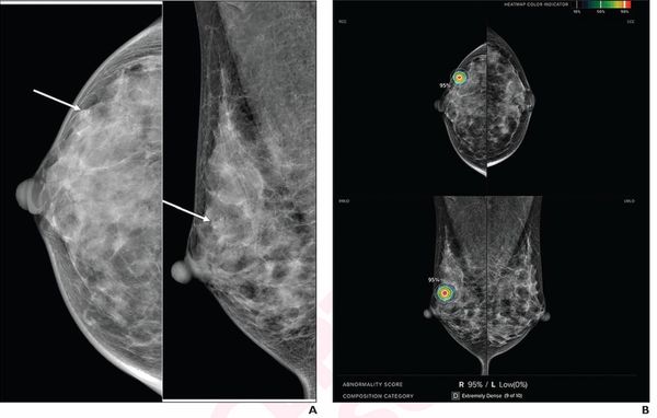 Mammography Study Assesses Ability of AI to Predict DCIS Recurrence After Breast Surgery