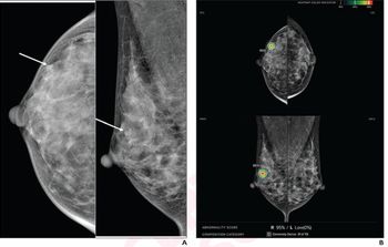 Mammography Study Assesses Ability of AI to Predict DCIS Recurrence After Breast Surgery