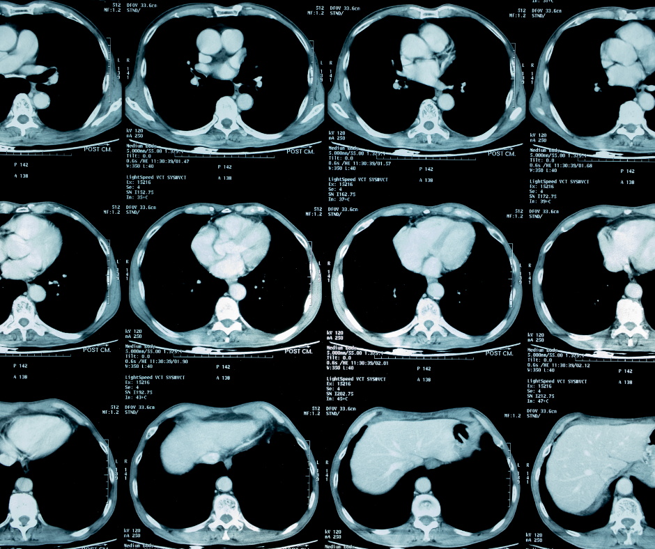 Study Looks at Potential Impact of Expanded Eligibility for LowDose CT