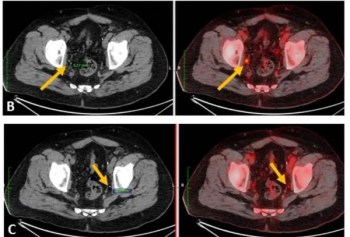 What a New Meta-Analysis Reveals About PET/CT Radiotracers for csPCa
