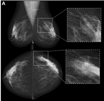 AI-Initiated Recalls After Screening Mammography Demonstrate Higher PPV for Breast Cancer