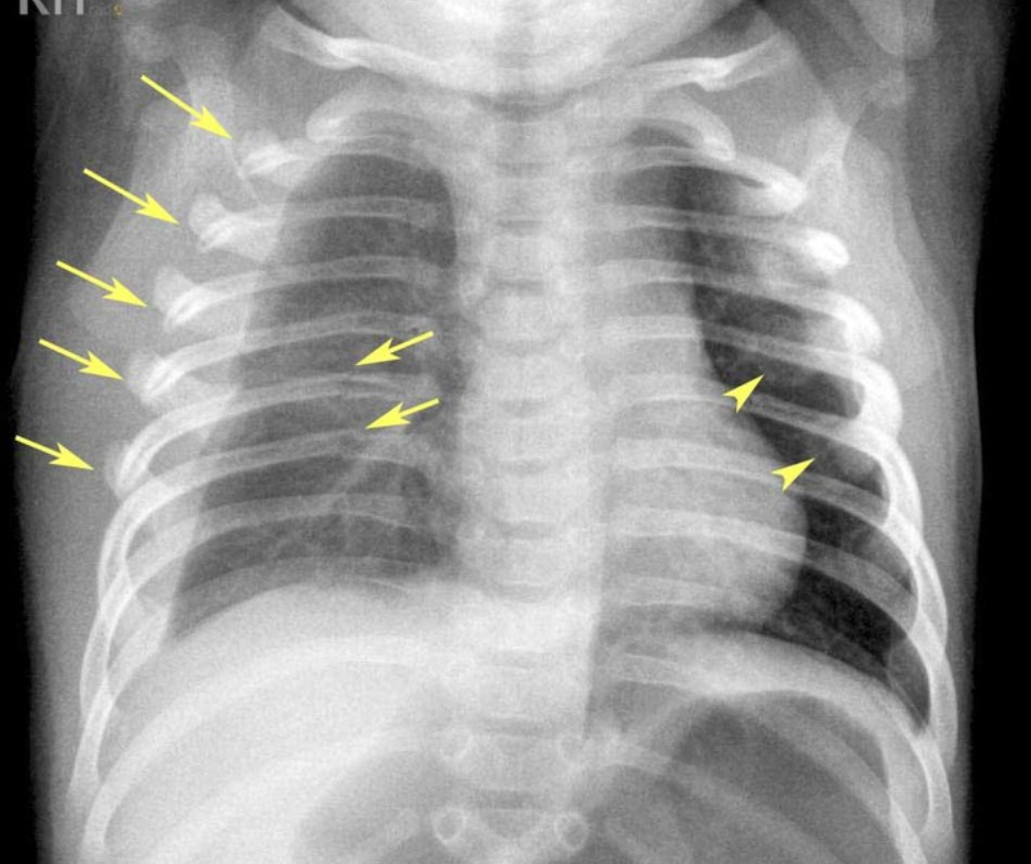 Newborn Ribs Image IQ Quiz: Multiple Rib Fractures in a Two-Month-Old Baby