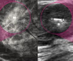 FDA Clears Multimodality Tumor Marker for Breast Cancer Imaging