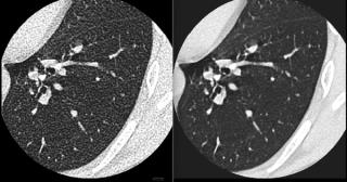 FDA Clears AI-Powered Software for Improving Low-Contrast CT Detection