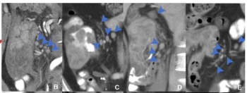 Could Lymph Node Distribution Patterns on CT Improve Staging for Colon Cancer?