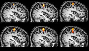 Robotic therapy expands recovery window for stroke patients
