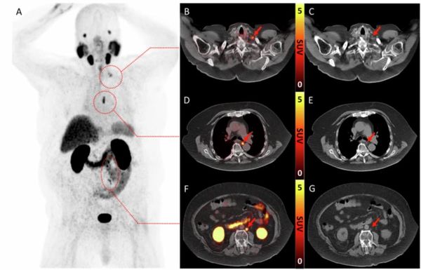  Nine Takeaways from New Review of PSMA PET/CT and Whole-Body MRI for Advanced Prostate Cancer