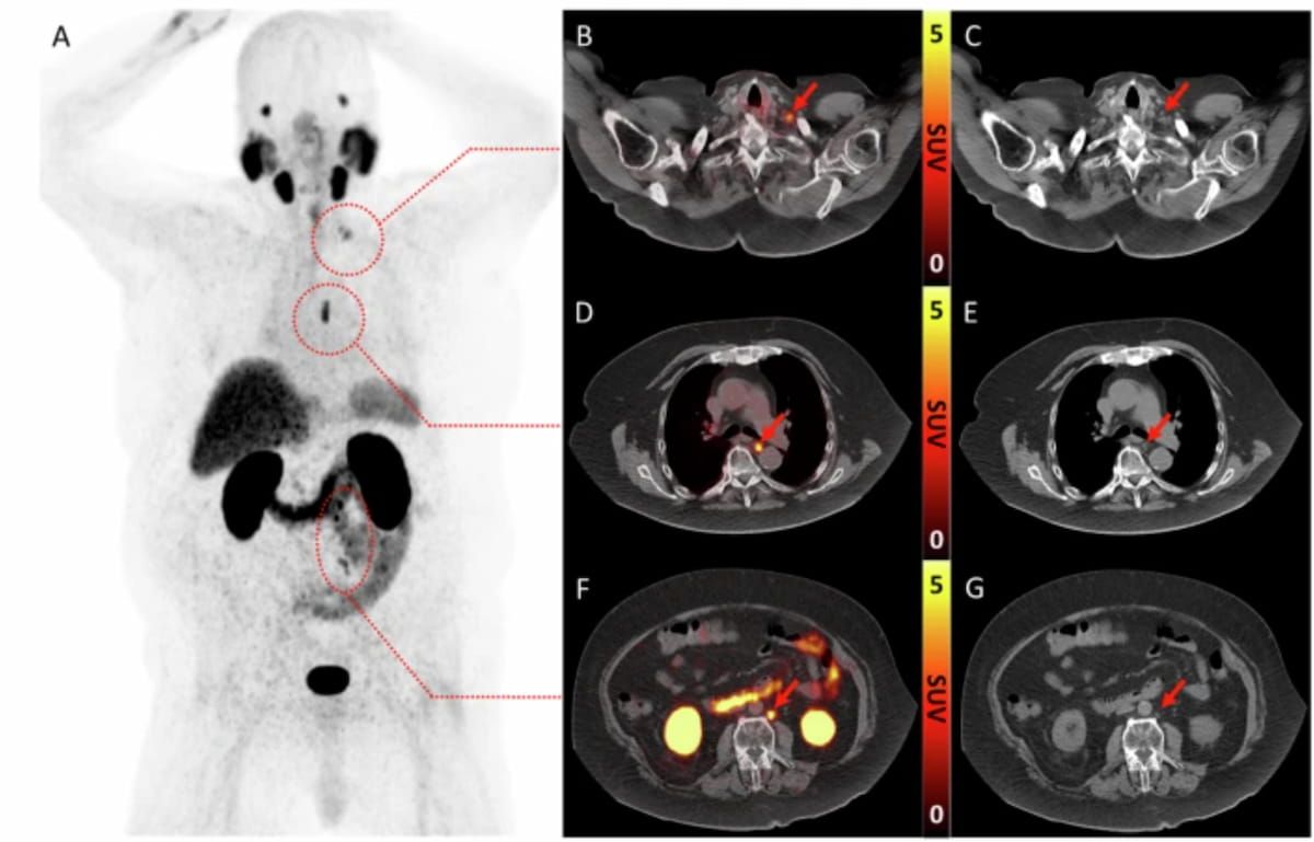 glp-1 pet scan imaging news Nine Takeaways from New Review of PSMA PET/CT and Whole-Body MRI for Advanced Prostate Cancer