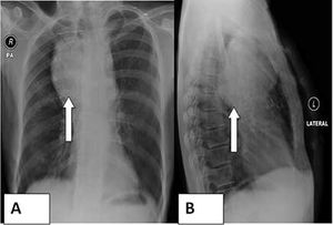 Aneurysm of Ascending Aorta and Arch of Aorta