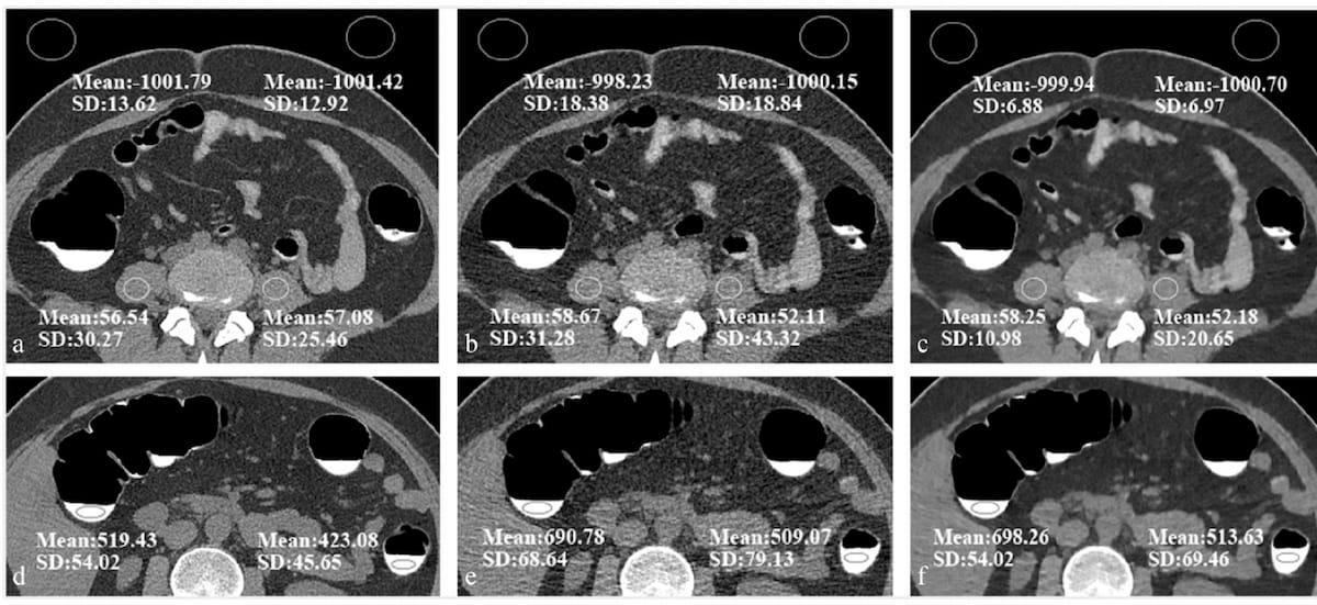 Study: Deep Learning Reconstruction Reduces Effective Dosing for CT Colonography by 83 Percent