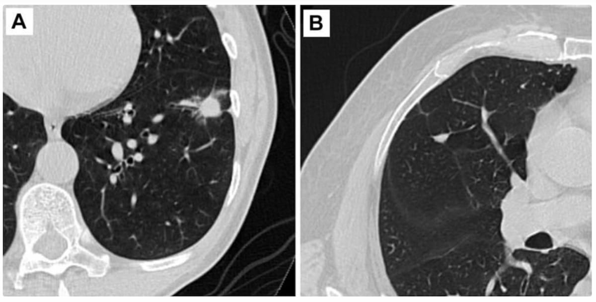 FDA Issues 510(k) Clearance of AI-Powered Assessment for Lung Cancer on Low-Dose CT Scans