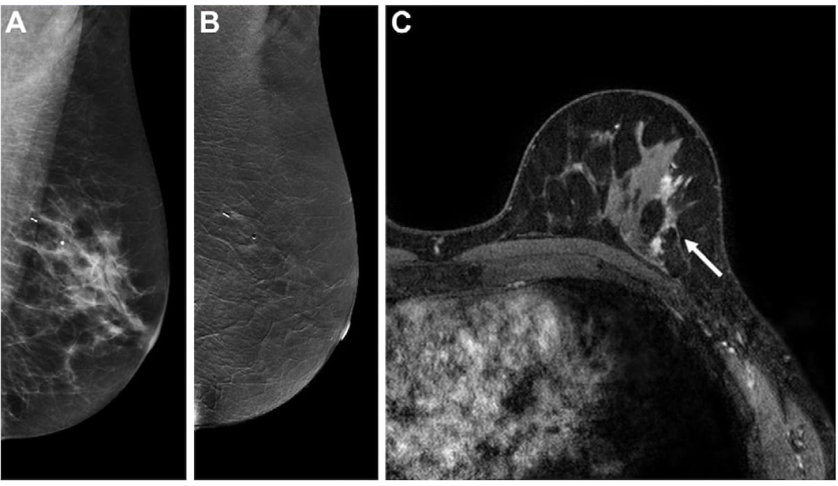 El estudio revela la compensación entre la mamografía de contraste y la resonancia magnética para la detección adyuvante