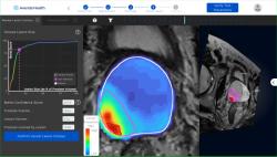 Could an Emerging AI Platform Supplant Traditional MRI for Assessing Prostate Cancer?