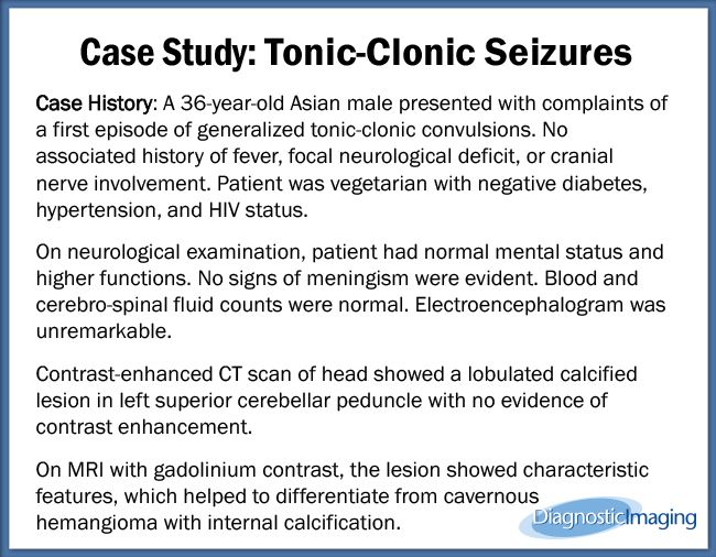 Tonic Clonic Seizures Tonic clonic seizures