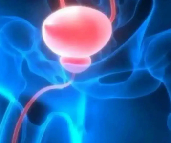 New PSMA PET Research Shows Merits of Pluvicto in Metastatic Hormone-Sensitive Prostate Cancer (mHSPC)