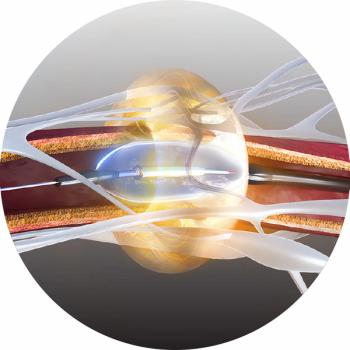 Ultrasound Renal Denervation System for Hypertension Garners CMS National Coverage Determination 