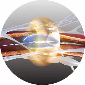 Ultrasound Renal Denervation System for Hypertension Garners CMS National Coverage Determination