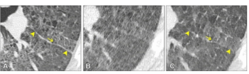 AI Denoising Bolsters Ultra-Low-Dose CT Detection of Pneumonia Findings in Immunocompromised Adults