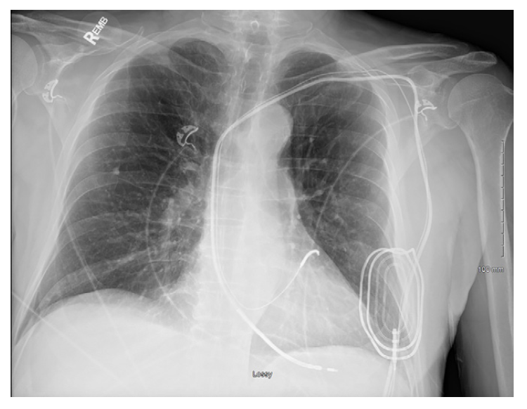 MRI Is Safe for Pacemaker Patients, Opening the Door for Needed Exams ...