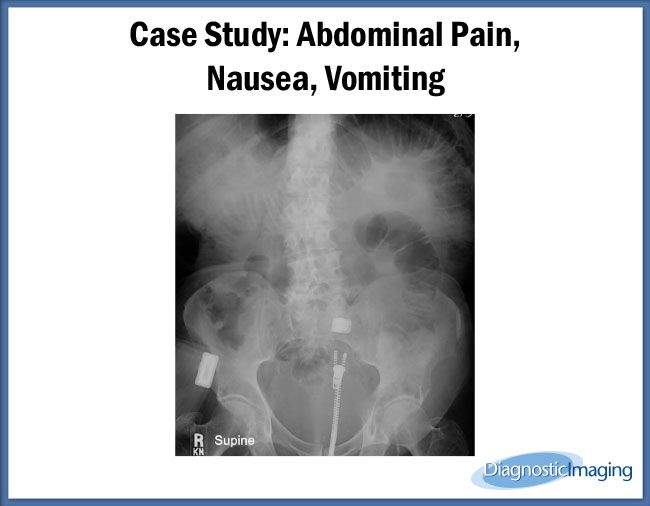 Abdominal Pain Nausea Vomiting Diagnostic Imaging