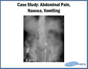 Abdominal Pain,  Nausea, Vomiting