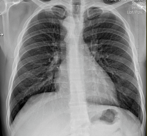 Image IQ Quiz: Asymptomatic Patient Presents with Respiratory Symptoms