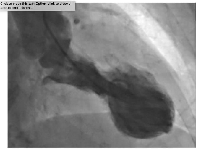 BLUE SYNDROME ドスベロ PET/CT shows link between stress and fatal heart condition