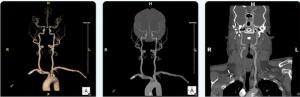 FDA Clears CTA-Based AI Software for Enhanced Visualization of Head and Neck Arteries