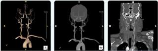FDA Clears CTA-Based AI Software for Enhanced Visualization of Head and Neck Arteries