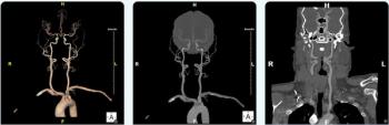 FDA Clears CTA-Based AI Software for Enhanced Visualization of Head and Neck Arteries