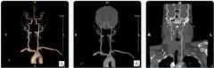 FDA Clears CTA-Based AI Software for Enhanced Visualization of Head and Neck Arteries