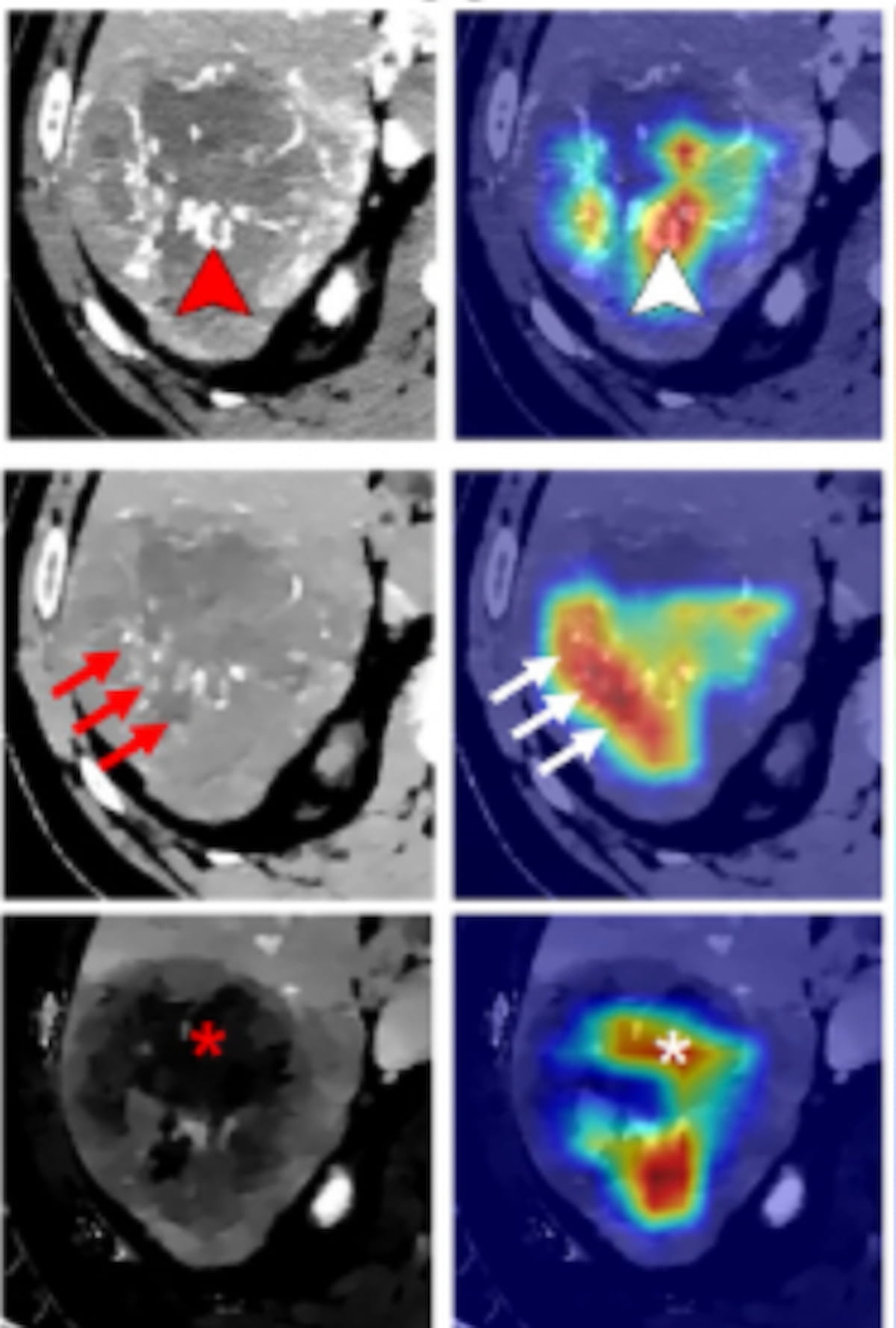 Bir CT tarama modeli büyük, masif karaciğer kanseri için risk değerlendirmesini iyileştirebilir mi?