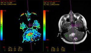 Cerebellar Hemangioblastoma