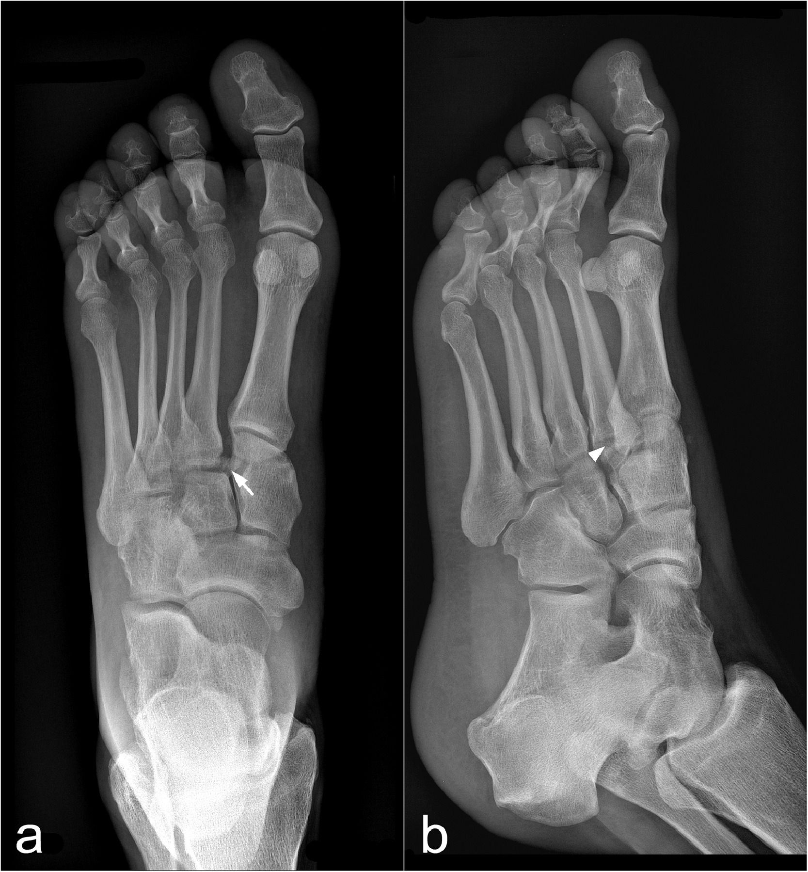 Study Says Ai Improves Sensitivity Of Fracture Detection By 20 Percent