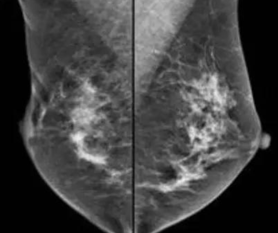 Study Finds No Benefit to MRI Screening in Women with High-Risk Breast Lesions