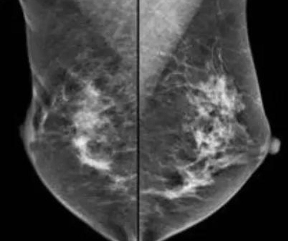 study-finds-no-benefit-to-mri-screening-in-women-with-high-risk-breast