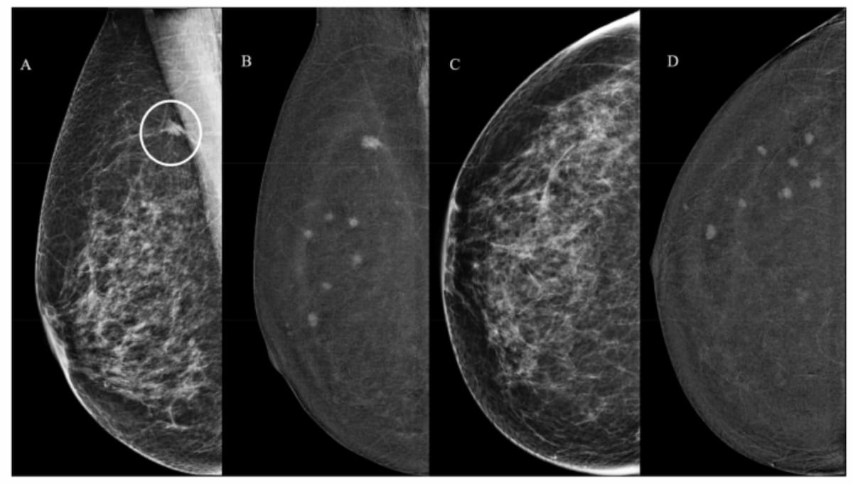 Can Contrast-Enhanced Mammography Improve Breast Cancer Staging?: Nine Takeaways from a New Literature Review