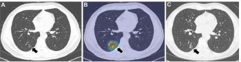 Can Deep Learning Enhance Low-Dose Chest CT Assessment of Lung Cancer Risk?