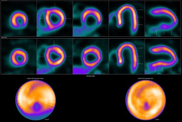 PET radiotracer for coronary artery disease