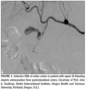 Embolotherapy controls largegastrointestinal bleeds safely