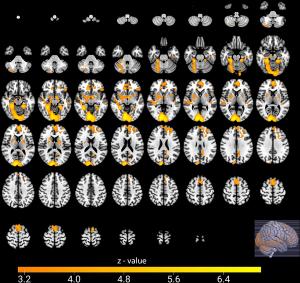 Study Assesses Brain MRI Changes in Soccer Fans
