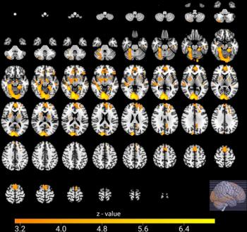 Study Assesses Brain MRI Changes in Soccer Fans