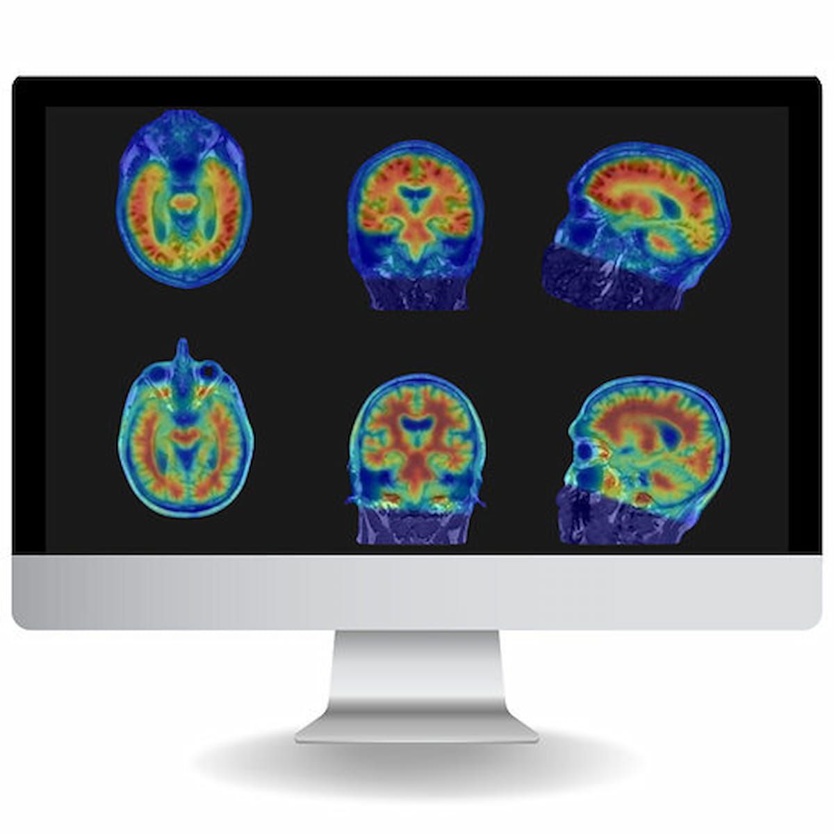 FDA Clears NeuroQuant PET for Assessment of Neurological Conditions