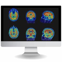 FDA Clears NeuroQuant PET for Assessment of Neurological Conditions