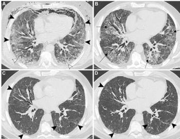 Chest CT for Post-COVID-19 Abnormalities: Nine Takeaways from a Multi-Society Consensus Statement