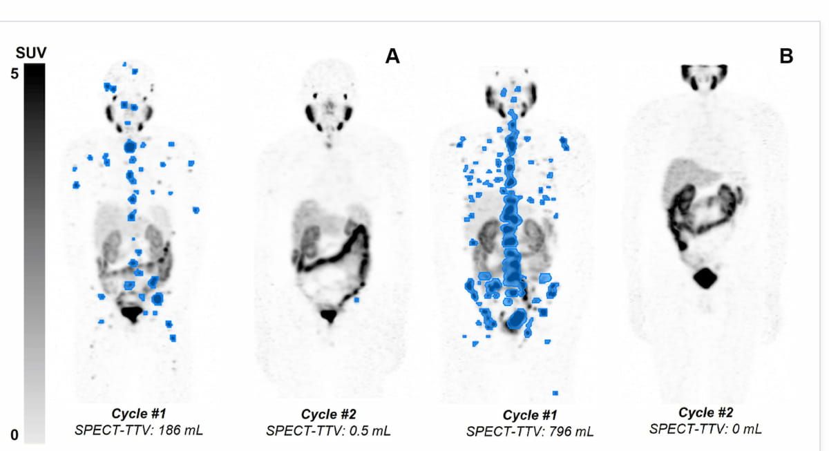 Early SPECT/CT Response After Pluvicto May Help Predict Survival in Patients with mCRPC
