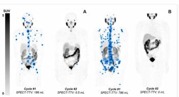Early SPECT/CT Response After Pluvicto May Help Predict Survival in Patients with mCRPC