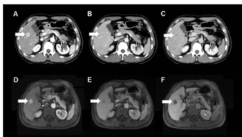 Are CT and MRI-Derived LI-RADS Assessments Effective for Detecting HCC in Cases of Non-Cirrhotic Chronic Hepatitis C?
