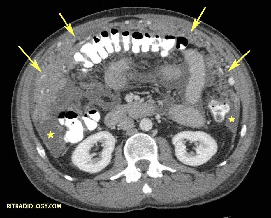 Image IQ Quiz: 56-Year-Old Man with Weight Loss and Gradual Abdominal Distention